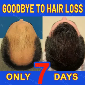 Hair growth products for men and women anti-hair loss rapid hair growth effective repair of baldness symptoms of hair loss