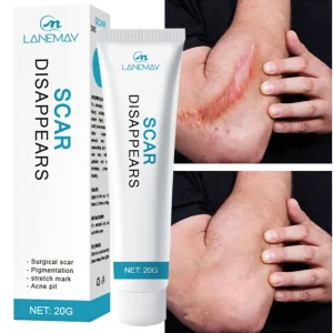 Scar Removal Cream Repair Stretch Marks Burn Acne Surgical Acne Scar Ointment Herbal Treatment Gel Whitening Beauty Health Care