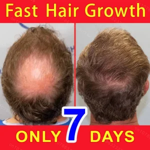 Fast Hair Growth for Men Women Hair spray Anti Hair Loss Products Scalp Treatment Repair Nourish Damaged Hairs Scalp